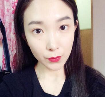 武漢中翰整形外科醫(yī)院陳志鵬醫(yī)生做雙眼皮修復效果怎么樣？附雙眼皮修復案例