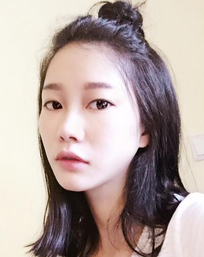 西安陽(yáng)光整形醫(yī)院邵萍醫(yī)生做鼻綜合整形怎么樣？附鼻綜合整形案例