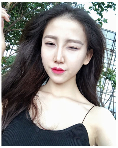 珠海海大整形美容外科黃發(fā)醫(yī)生做面部吸脂怎么樣？附面部吸脂案例