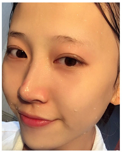 珠海海大整形美容外科黃發(fā)醫(yī)生做面部吸脂怎么樣？附面部吸脂案例