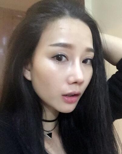 西安陽(yáng)光整形醫(yī)院邵萍醫(yī)生做鼻綜合整形怎么樣？附鼻綜合整形案例