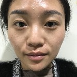 石家莊雅芳亞整形醫(yī)生王文明做雙眼皮+開(kāi)眼角+鼻綜合整形案例效果對(duì)比圖