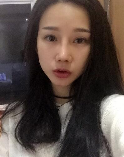 西安陽(yáng)光整形醫(yī)院邵萍醫(yī)生做鼻綜合整形怎么樣？附鼻綜合整形案例