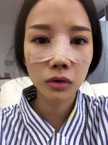 西安陽(yáng)光整形醫(yī)院邵萍醫(yī)生做鼻綜合整形怎么樣？附鼻綜合整形案例