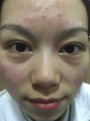 西安壹加壹整形醫(yī)院劉晨醫(yī)生做點(diǎn)陣激光祛痘效果怎么樣？附點(diǎn)陣激光祛痘效果圖