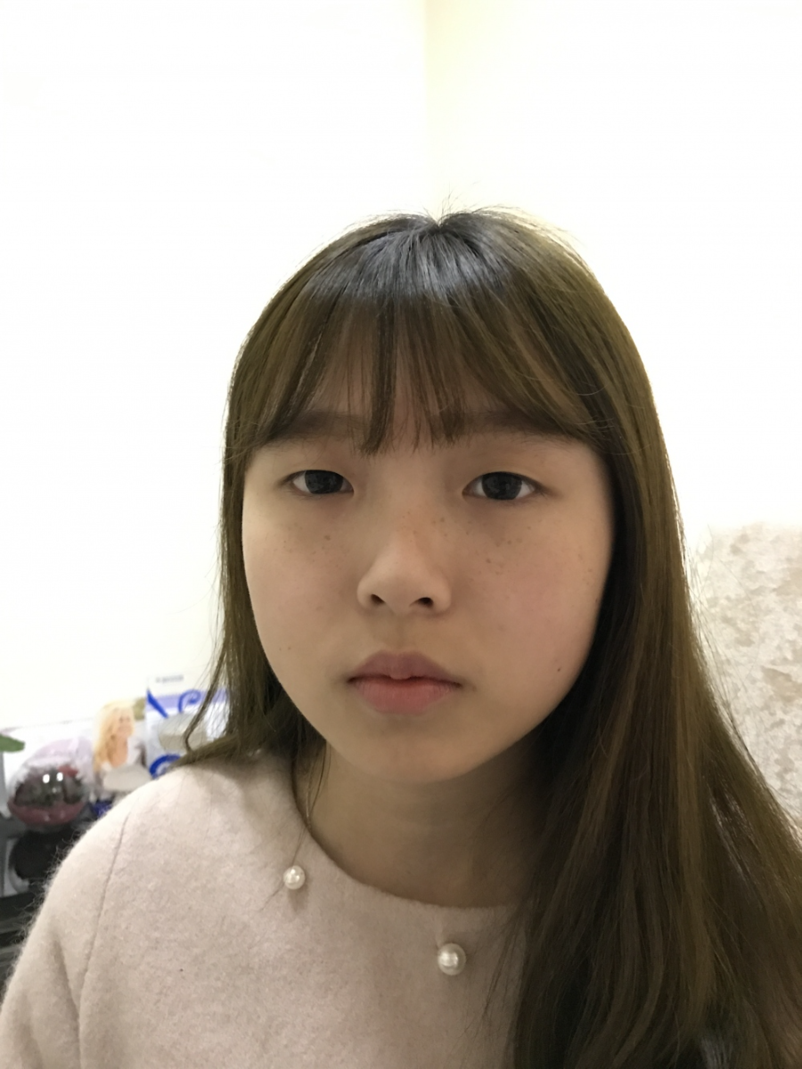 西安米蘭柏羽整形醫(yī)院李旭平做雙眼皮+開眼角技術(shù)怎么樣？附醫(yī)院案例