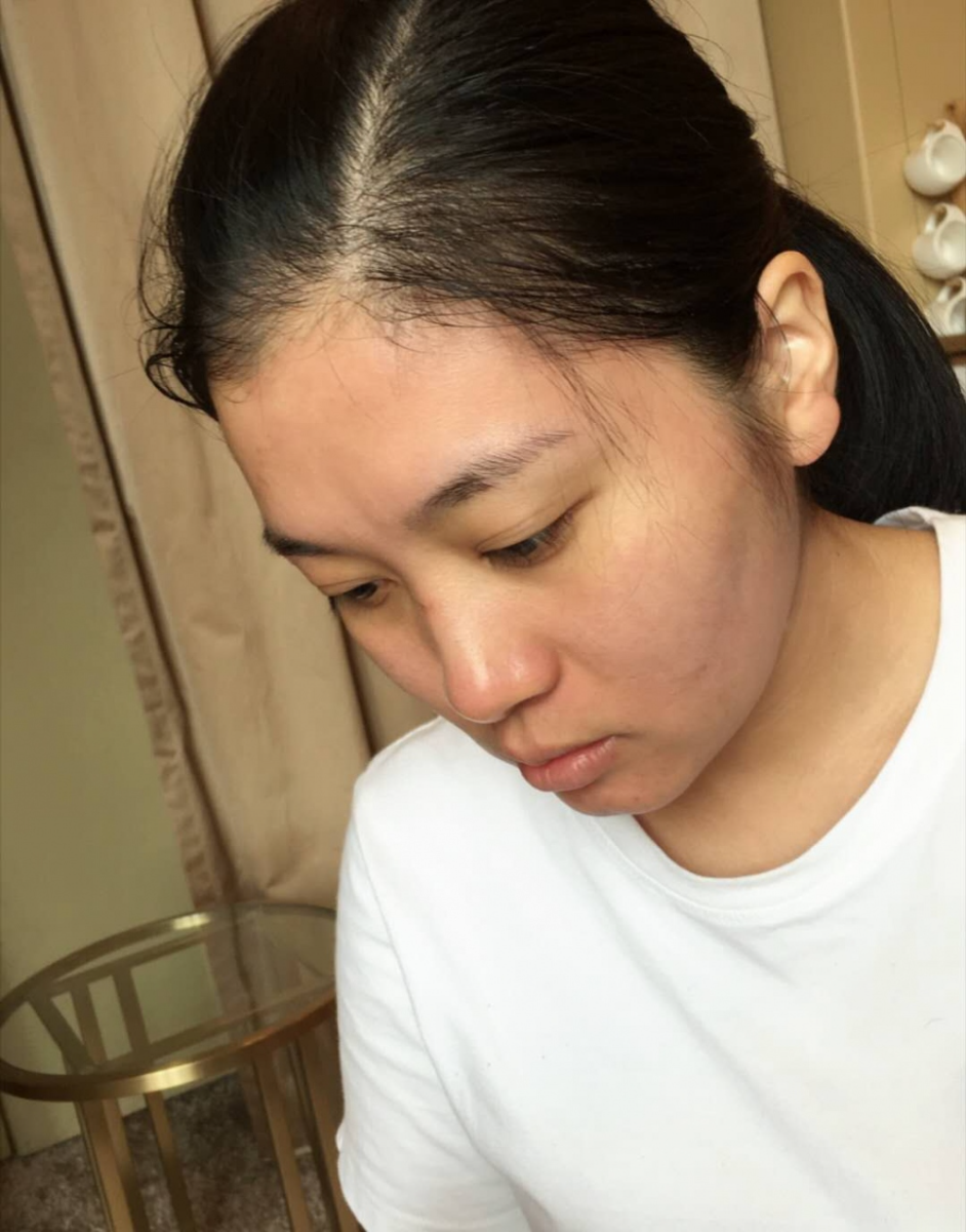 哈爾濱禾力康整形醫(yī)院劉亞春醫(yī)生做點(diǎn)陣激光去痘印效果怎么樣？附案例