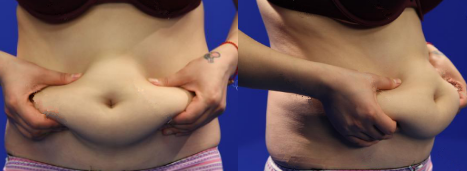 廣州韓佳人整形醫(yī)院詹曉芳做腹部吸脂效果怎么樣？附案例效果對比圖