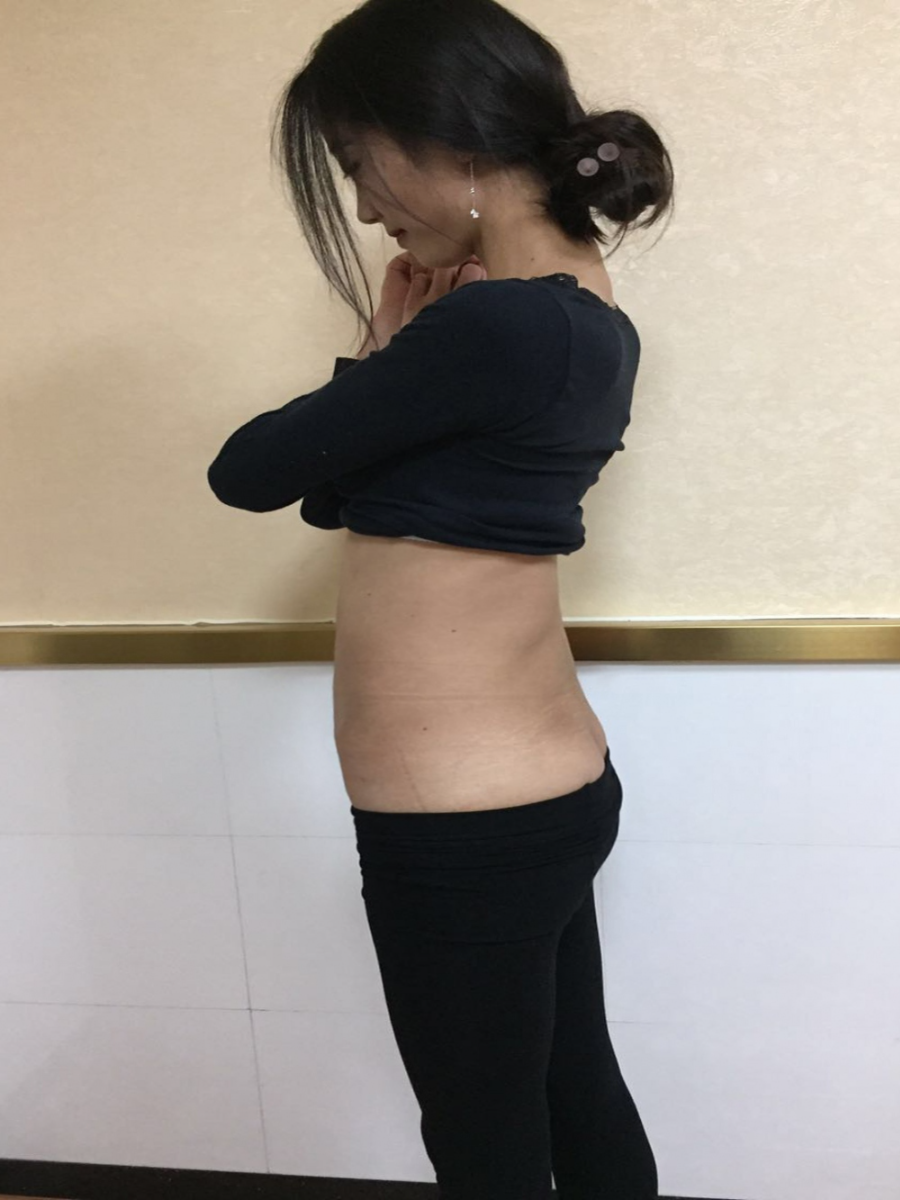 北京東方瑞麗整形醫(yī)生夏兆驥做腰腹吸脂效果怎么樣？附腰腹吸脂案例效果對比圖