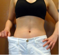 廣州韓佳人整形醫(yī)院詹曉芳做腹部吸脂效果怎么樣？附案例效果對比圖