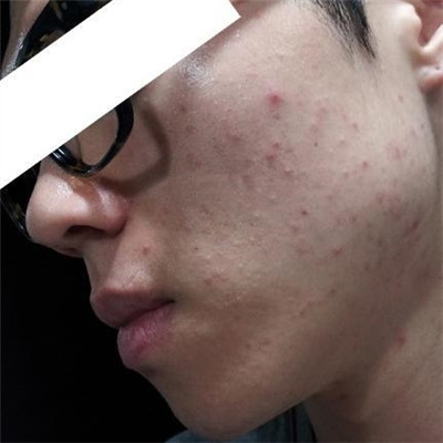 浙江綠城醫(yī)院整形美容中心丁路醫(yī)生做激光祛痘效果怎么樣，附案例對比圖