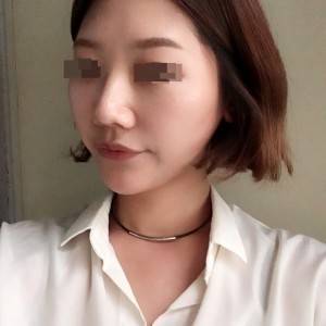 太原麗都整形醫(yī)院劉晉艷醫(yī)生做光纖溶脂瘦臉怎么樣？附案例效果對(duì)比圖