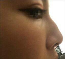 天津時光整形醫(yī)生盧丙侖做駝峰鼻怎么樣？附案例效果對比圖