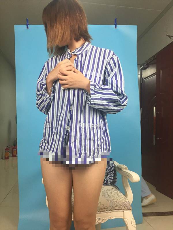 北京蒂凡妮整形靳玉彪醫(yī)生做大腿吸脂怎么樣？附大腿吸脂案例效果對比圖