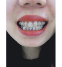 安徽天鵝湖口腔醫(yī)院張永莉醫(yī)生做牙齒矯正怎么樣？附牙齒矯正案例效果對(duì)比圖