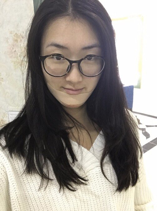 武漢中翰整形外科醫(yī)院做硅膠墊下巴怎么樣？附朱紅霞醫(yī)生案例效果對(duì)比圖