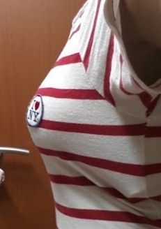 廣州基立嘉韓醫(yī)學整形醫(yī)院醫(yī)生劉朝忠做假體隆胸怎么樣？附案例效果對比圖