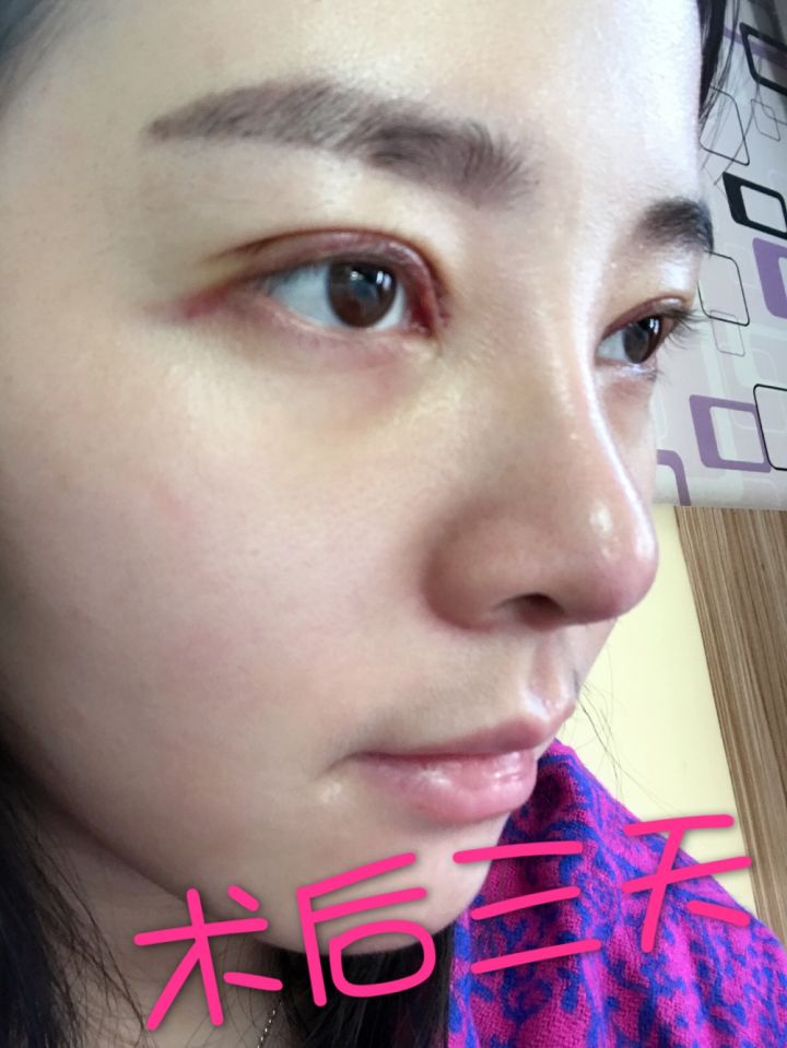 北京京韓整形醫(yī)生王義山做埋線雙眼皮怎么樣？附案例效果對比圖