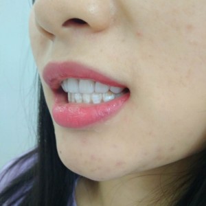 洛陽(yáng)友好口腔醫(yī)院醫(yī)生李新然做牙貼面怎么樣？附案例效果圖