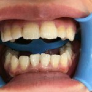 洛陽友好口腔醫(yī)院醫(yī)生楊愛芳做牙齒冷光美白怎么樣？附案例效果圖