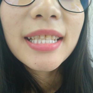 洛陽(yáng)友好口腔醫(yī)院醫(yī)生李新然做牙貼面怎么樣？附案例效果圖