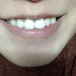 洛陽(yáng)友好口腔醫(yī)院醫(yī)生楊愛(ài)芳做牙齒冷光美白怎么樣？附案例效果圖