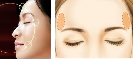 珠海仁愛(ài)整形豐太陽(yáng)穴