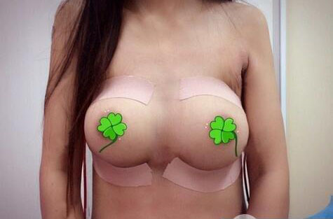 海南伊佳醫(yī)療美容醫(yī)院醫(yī)生涂陽君做假體隆胸怎么樣？附案例效果對比圖