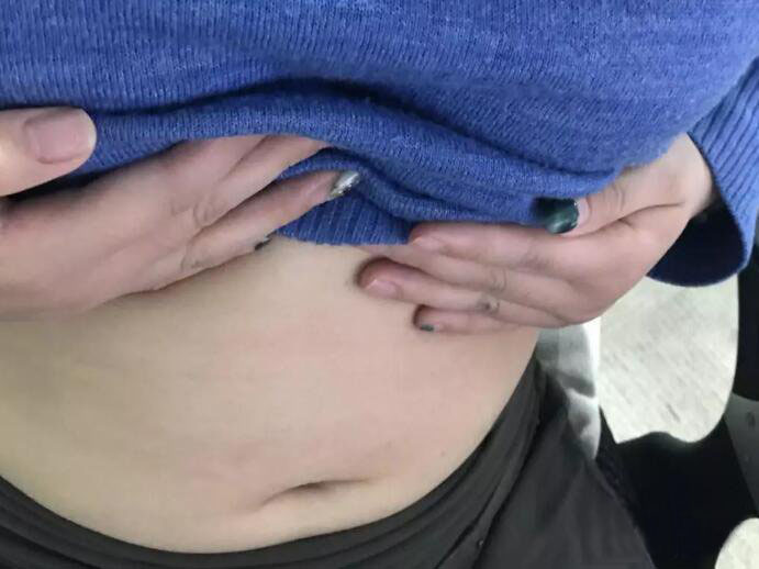 廣州尚美善造美容醫(yī)院醫(yī)生邵方做水動(dòng)力吸脂怎么樣？附案例效果圖