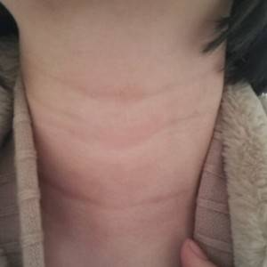 昭通愛麗諾整形醫(yī)生陳志江做嗨體去頸紋怎么樣？附案例效果圖