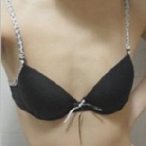 三亞圣迪亞整形美容醫(yī)院醫(yī)生韓超做假體隆胸怎么樣？附案例效果對比圖