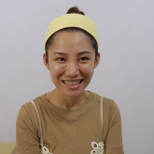 保定東陽口腔醫(yī)院醫(yī)生白小青做牙齒冷光美白怎么樣？附案例效果對(duì)比圖