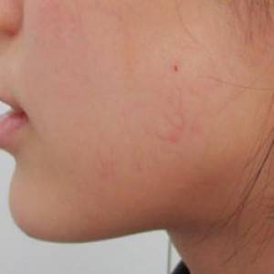 蚌埠韓美美萊整形醫(yī)院醫(yī)生張濤做玻尿酸墊下巴怎么樣？來(lái)看案例效果圖