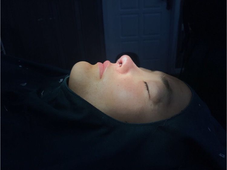 北京集美名媛醫(yī)療整形醫(yī)生陳瀅雯做自體耳軟骨隆鼻怎么樣？附案例效果圖