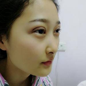 周口垣夢(mèng)醫(yī)療整形醫(yī)生王濤做切開(kāi)雙眼皮怎么樣？附切開(kāi)雙眼皮案例效果對(duì)比圖