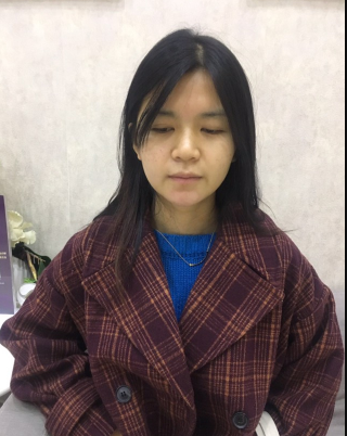 上海時光整形外科醫(yī)院醫(yī)生何晉龍做假體隆胸怎么樣？附案例效果對比圖