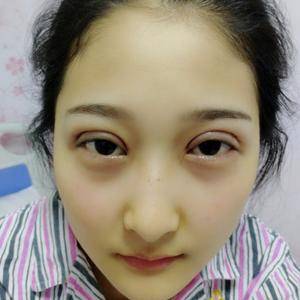 周口垣夢(mèng)醫(yī)療整形醫(yī)生王濤做切開(kāi)雙眼皮怎么樣？附切開(kāi)雙眼皮案例效果對(duì)比圖