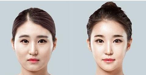 青島集美整形醫(yī)院顴骨整形