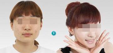 陜西華西醫(yī)院西美整形美容中心下頜角整形