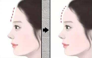 商丘柳志成醫(yī)療美容診所豐額頭