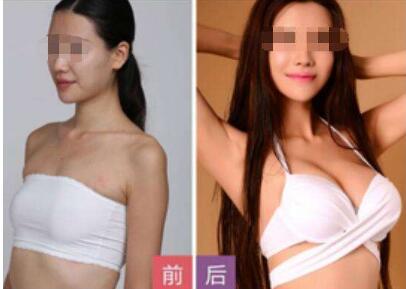 成都魅麗經(jīng)緯整形美容醫(yī)院假體隆胸