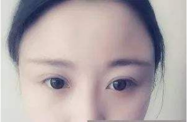 海南華美醫(yī)學(xué)美容醫(yī)院自體脂肪豐太陽穴