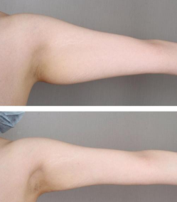 上海天大醫(yī)療美容醫(yī)院手臂吸脂