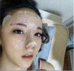 上海時(shí)光整形醫(yī)生何晉龍做假體隆鼻效果怎么樣？附案例效果對比圖