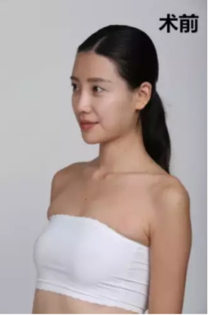 上海時(shí)光整形醫(yī)院何晉龍醫(yī)生做假體隆胸怎么樣？附案例對比圖