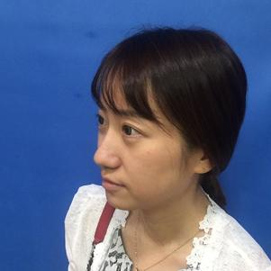 蚌埠韓美美萊整形做玻尿酸面部除皺效果怎么樣？附陳澤醫(yī)生案例效果圖