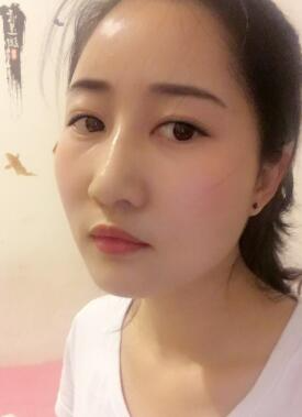 鞍山菲之都整形醫(yī)生李宗亮做字體脂肪豐太陽穴效果怎么樣？附案例效果對比圖