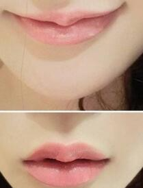 巴中時(shí)光醫(yī)學(xué)美容門診部做玻尿酸豐唇效果怎么樣？附李紅強(qiáng)豐唇案例