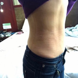 蚌埠韓美美萊整形醫(yī)生張濤做水動力吸脂怎么樣？附吸脂案例效果圖