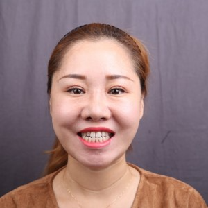 保定東陽口腔醫(yī)院趙晨醫(yī)生做瓷貼面怎么樣？附瓷貼面案例效果對比圖